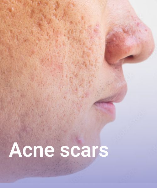 acne scars