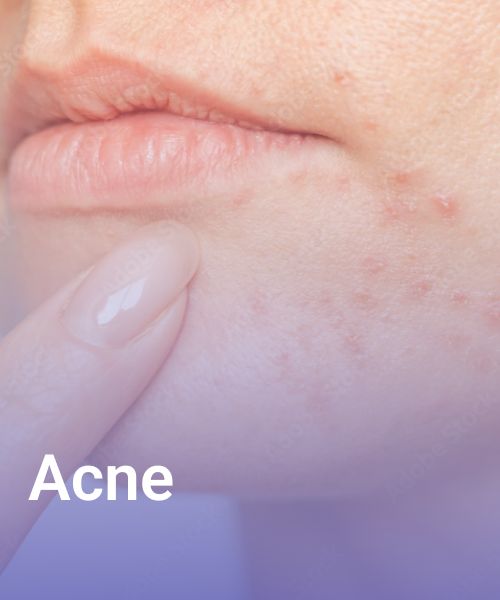 Face chin acne