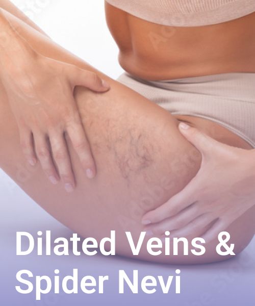 dilated veins & spider nevi 