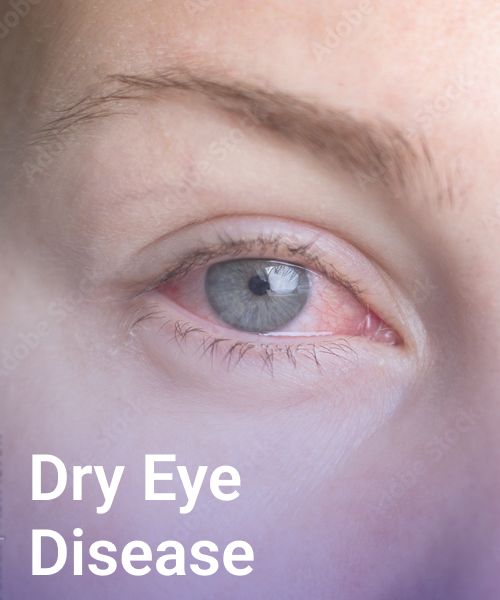 dry eye disease