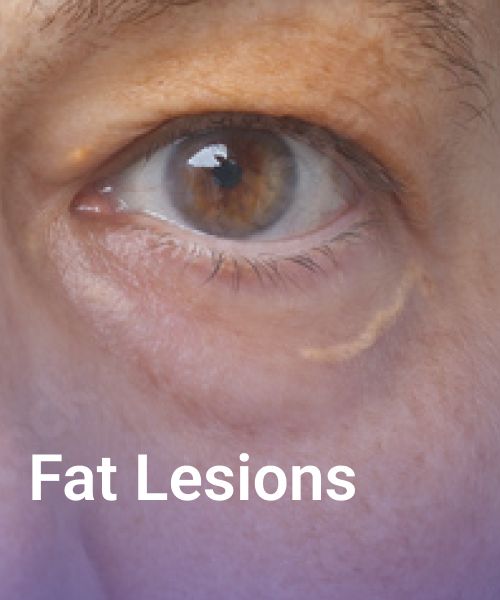 fat lesions