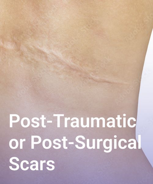 post traumatic and post surgical scars
